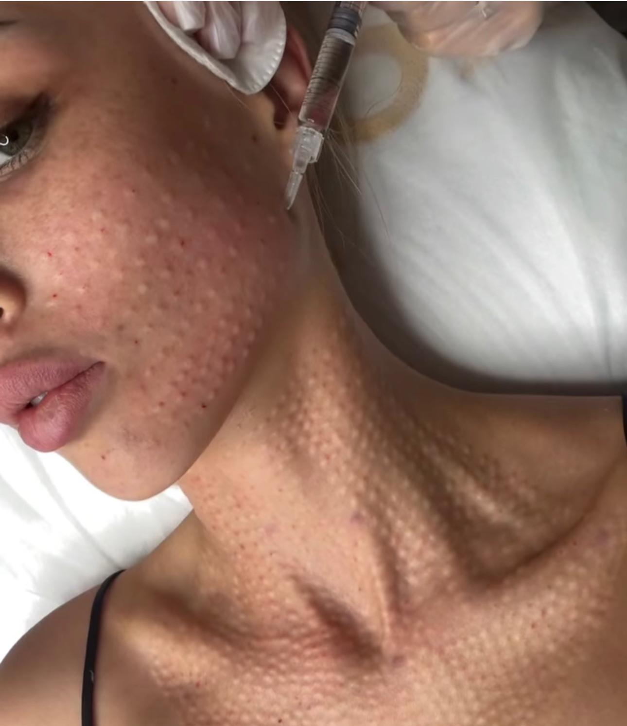 Collagen biostimulator